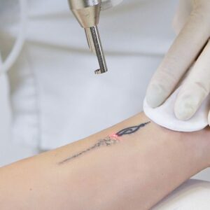 rimozione laser tatuaggi medicalspa brescia